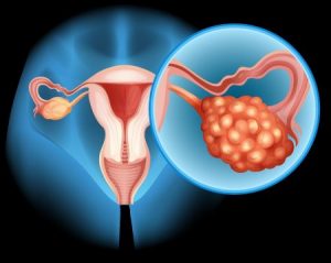 Symptoms of ovarian cancer and ways to treat it