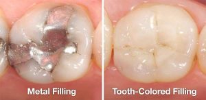 Stages of denervation and Dental Filling