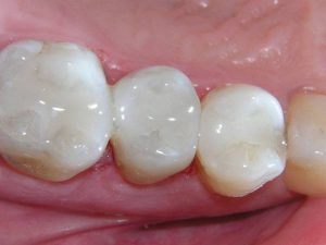 Stages of denervation and Dental Filling