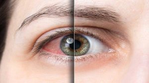 Eye sensitivity to light, causes, and treatment methods