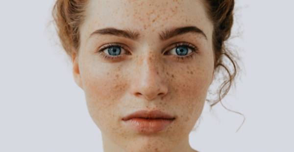Using herbal remedies and home remedies to treat brown skin blemishes