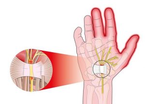 Carpal tunnel syndrome; The most common disease lurking in computer users