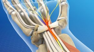 Carpal tunnel syndrome; The most common disease lurking in computer users