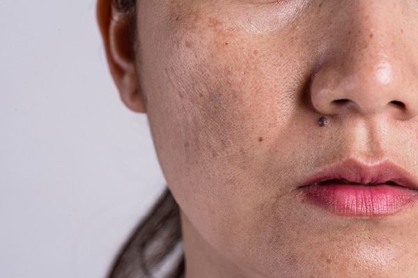 Using herbal remedies and home remedies to treat brown skin blemishes