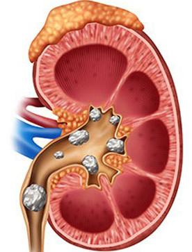 Kidney stones and methods of prevention and treatment