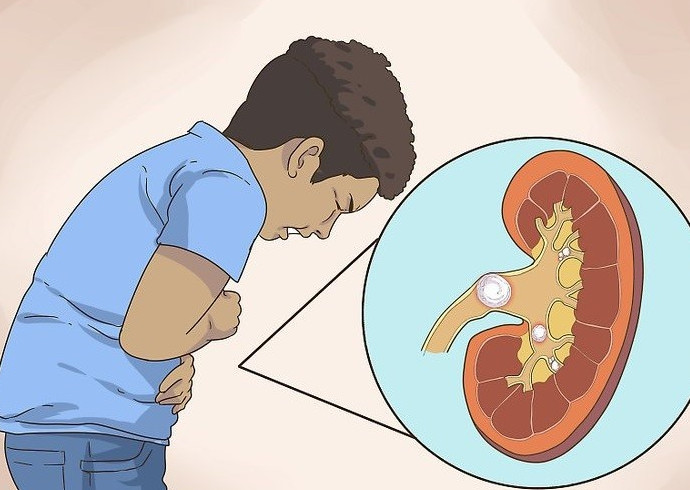 Calcoli renali e metodi di prevenzione e trattamento