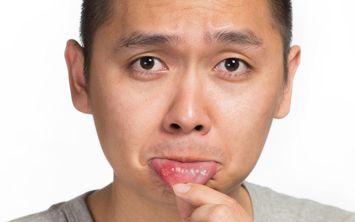 14 rimedi casalinghi per curare la peste orale