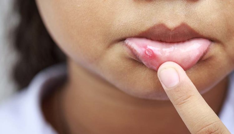 14 home remedies to treat oral plague