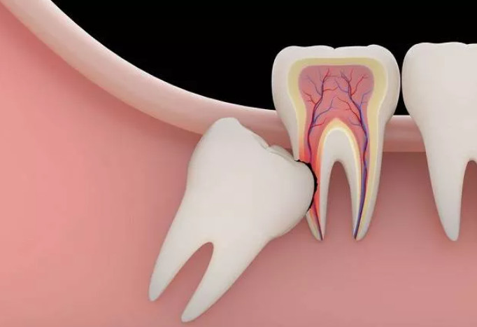 How do wisdom teeth erupt and when can they be extracted?