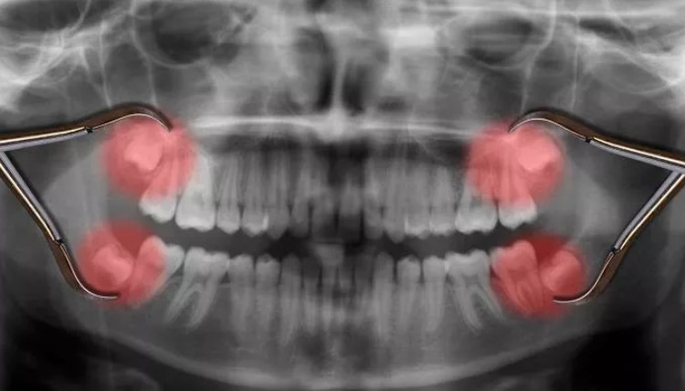 How do wisdom teeth erupt and when can they be extracted?