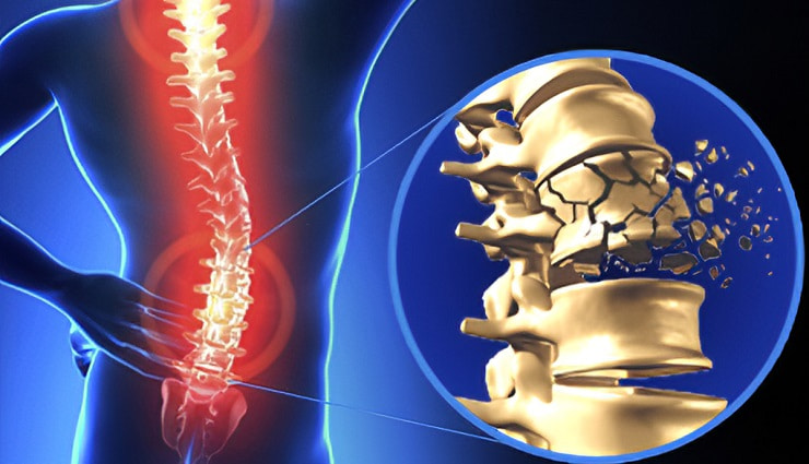 Lesiones de la médula espinal: tipos, síntomas, tratamiento y prevención