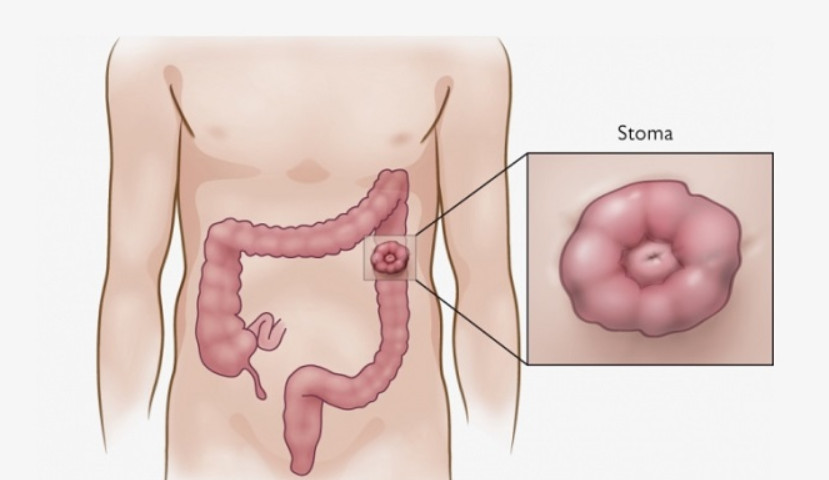Comment prendre soin de la stomie