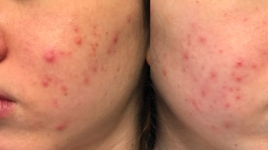 vitamina a para acne