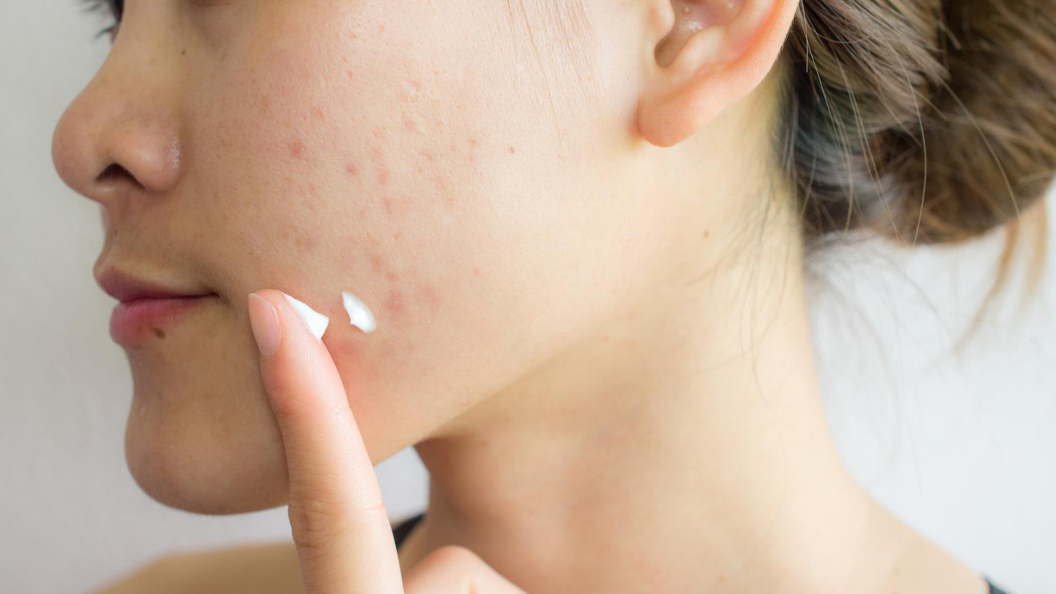 reseñas de vitamina a para el acné