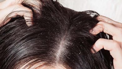 What Causes Dandruff and How to Manage It?
