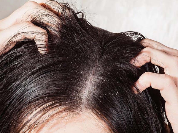 What is the cause of dandruff ? + Video