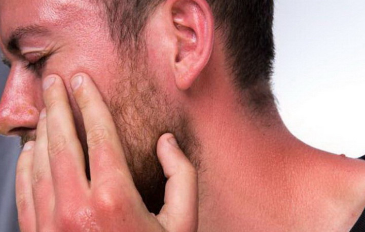 How to Prevent Sunburn: Tips and Strategies
