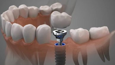A guide to caring for your dental implants