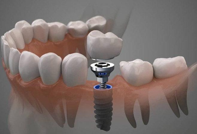 A guide to caring for your dental implants + video