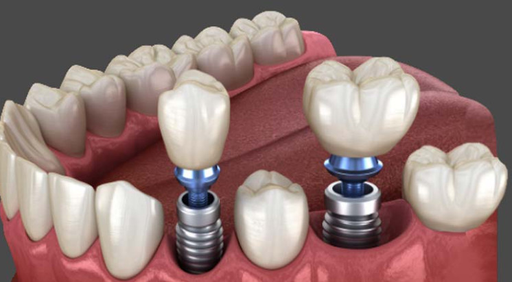 A guide to caring for your dental implants + video