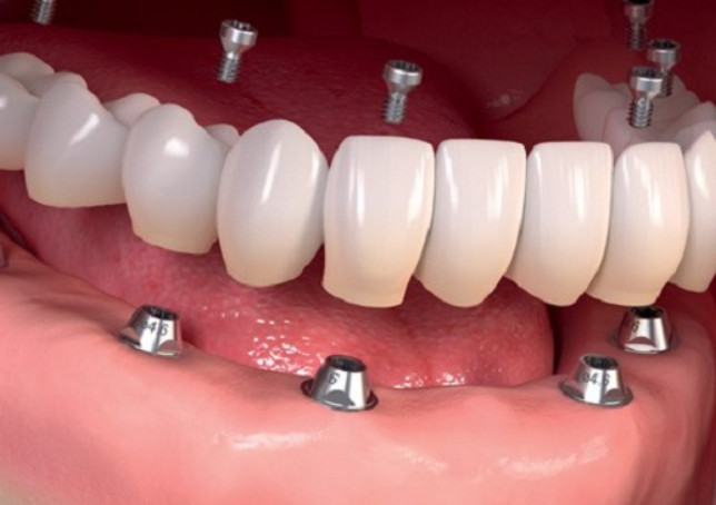 A guide to caring for your dental implants