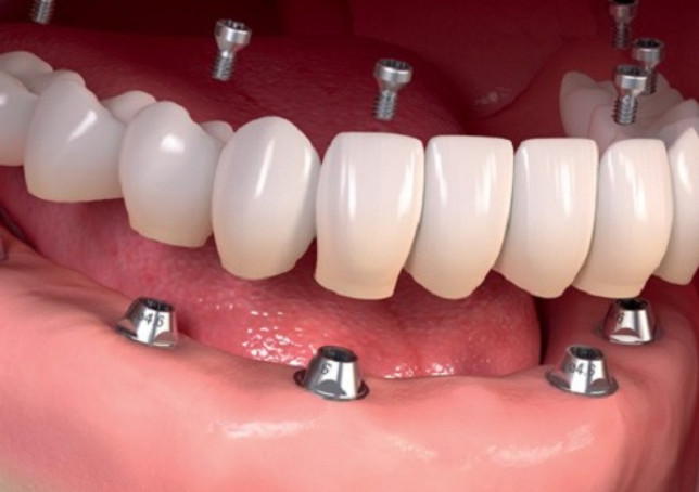 A guide to caring for your dental implants + video