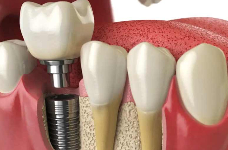 A guide to caring for your dental implants + video