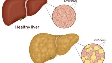 Understanding Nonalcoholic Steatohepatitis (NASH) - A Guide to Symptoms