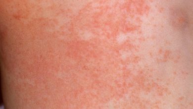 How do you treat heat rash in the summer?