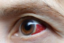 Redness in one eye without pain