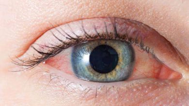 Home remedies for red eyes