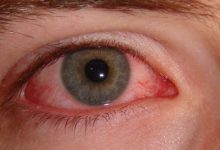 How to treat red eyes