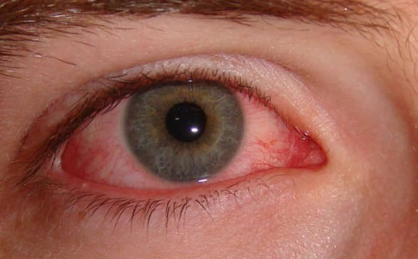 How to treat red eyes